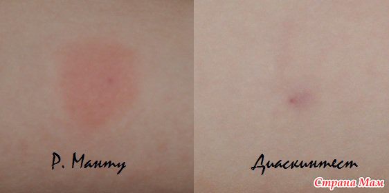 Диаскинтест &mdash; что это такое, оценка результатов, отличие от манту