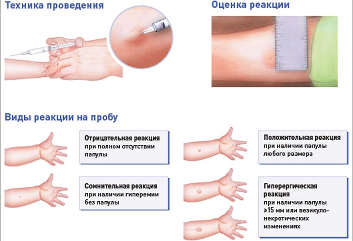 Диаскинтест &mdash; что это такое, оценка результатов, отличие от манту