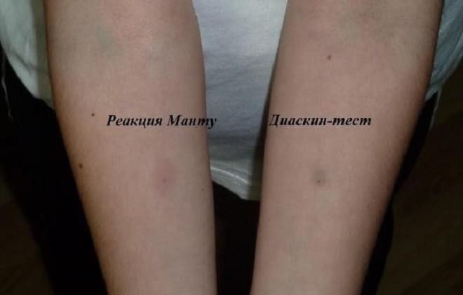 Диаскинтест &mdash; что это такое, оценка результатов, отличие от манту