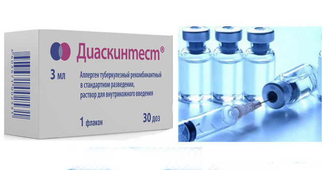 Диаскинтест &mdash; что это такое, оценка результатов, отличие от манту