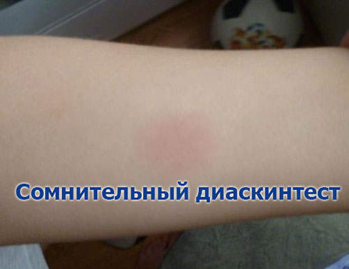 Диаскинтест &mdash; что это такое, оценка результатов, отличие от манту