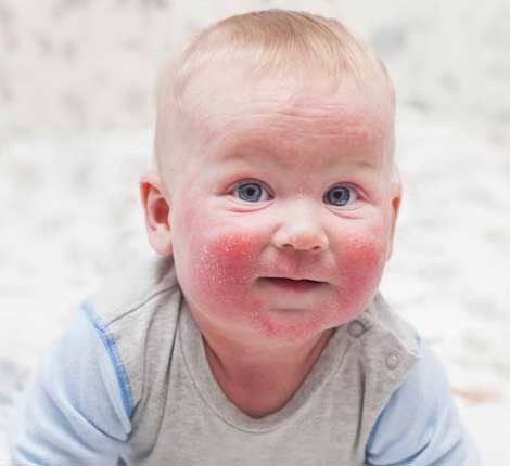 Диатез у детей, меры профилактики, народное лечение