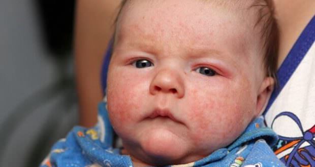 Диатез у детей, меры профилактики, народное лечение