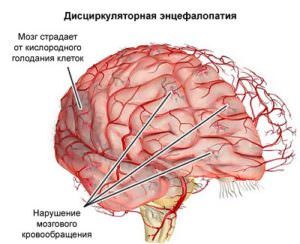 Дисциркуляторная энцефалопатия – код по мкб-10