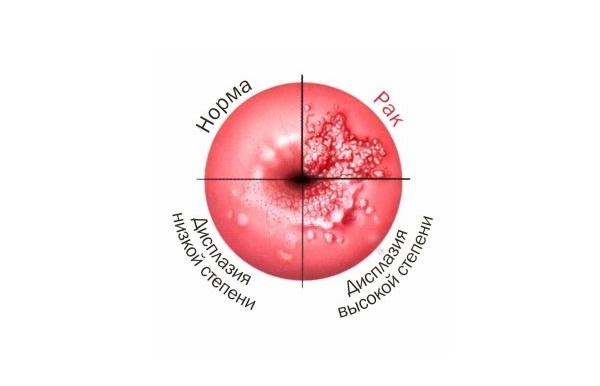 Дисплазия шейки матки: предраковое состояние, возможные осложнения, методы лечения дисплазии матки 