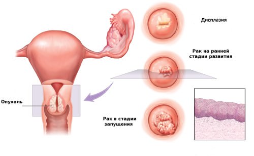 Дисплазия шейки матки &mdash; причины, симптомы, лечение