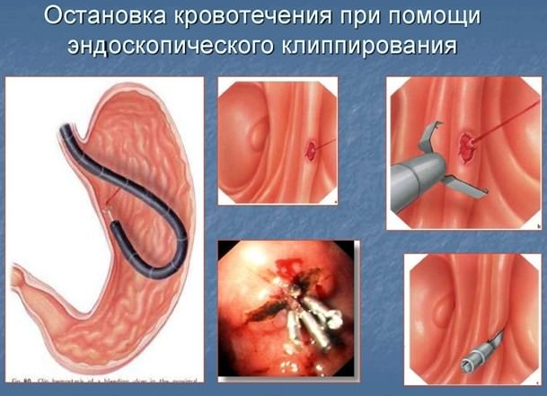 Дивертикул меккеля: врач-гастроэнтеролог о выявлении скрытой проблемы через анализ 5 осложнений заболевания