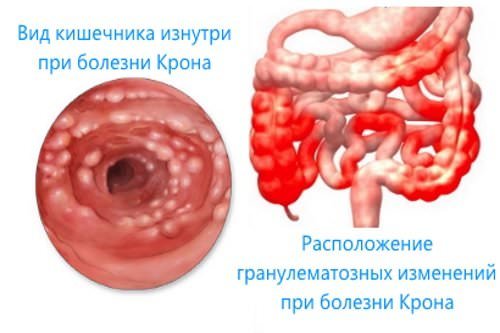 Дивертикул меккеля: врач-гастроэнтеролог о выявлении скрытой проблемы через анализ 5 осложнений заболевания