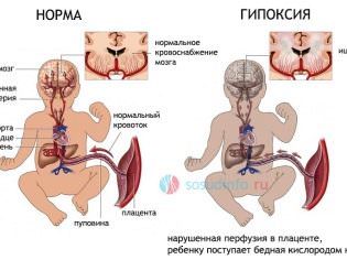 Дизартрия у детей симптомы, лечение и прогноз речи ребенка