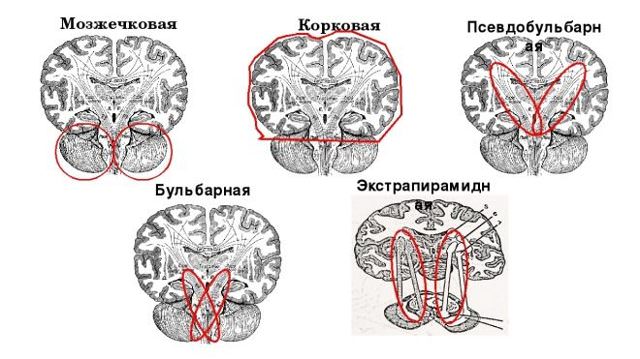 Дизартрия у детей симптомы, лечение и прогноз речи ребенка