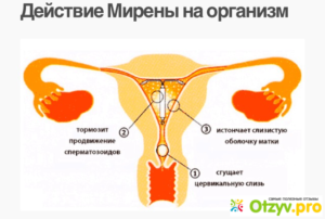Для чего необходима спираль мирена при менопаузе?