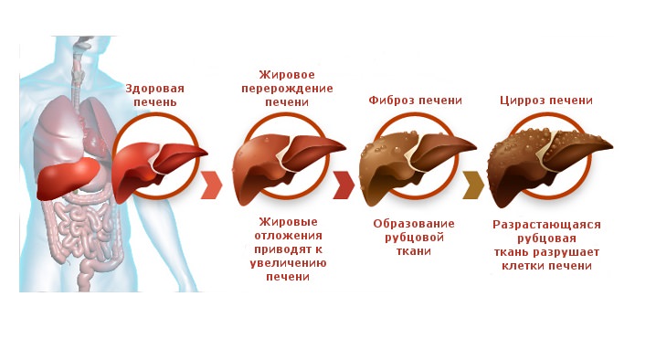 Для цирроза печени важна своевременная диагностика