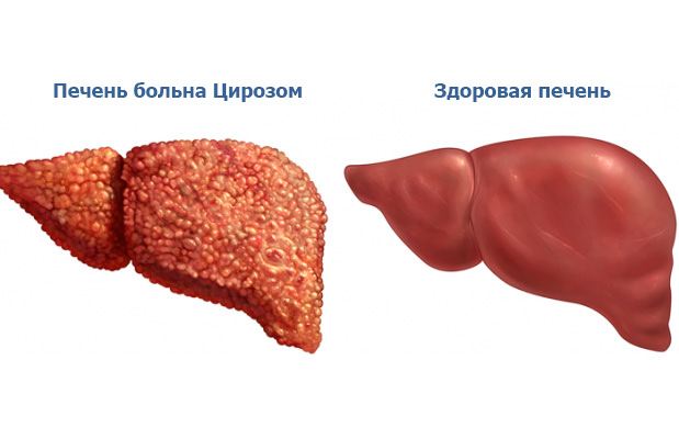 Для цирроза печени важна своевременная диагностика