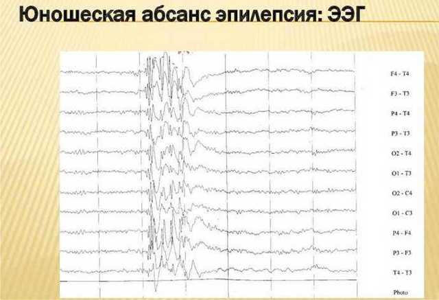 Доброкачественная ювенильная миоклоническая юношеская эпилепсия