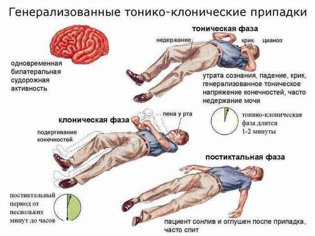 Доброкачественная ювенильная миоклоническая юношеская эпилепсия