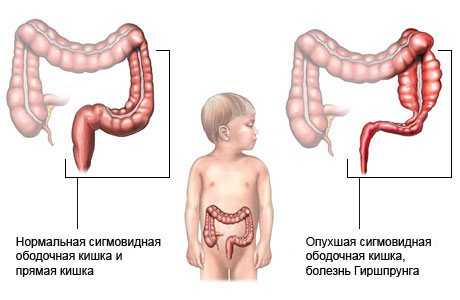 Долихосигма: 7 вариантов лечения и 8 правил питания ребёнка