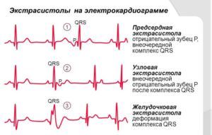 Экстрасистолы при всд, симптомы и разновидности