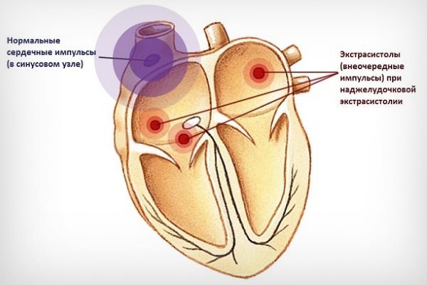 Экстрасистолы при всд, симптомы и разновидности