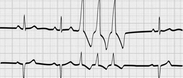 Экстрасистолы при всд, симптомы и разновидности
