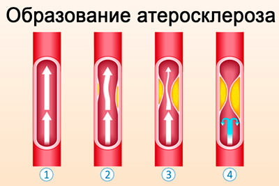 Элтацин при всд у взрослых, отзывы о лекарстве и инструкция к таблеткам