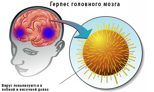 Энцефалит головного мозга: симптомы, лечение детей, как передается вирус, последствия