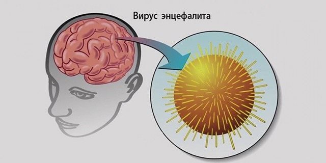 Энцефалитный менингит: причины, как передается, последствия