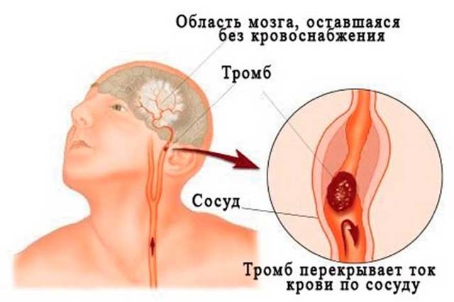 Энцефалопатия головного мозга и ее лечение у взрослых