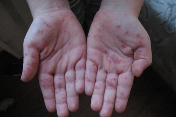 Энтеровирус у детей – симптомы, лечение, профилактика, диета