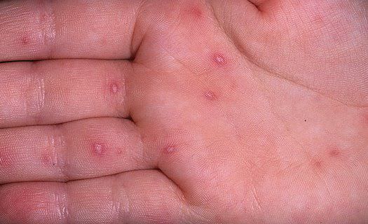 Энтеровирус у детей – симптомы, лечение, профилактика, диета