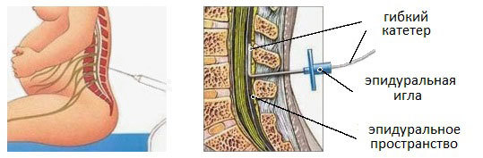 Эпидуральная анестезия при родах: отзывы врачей и недостатки