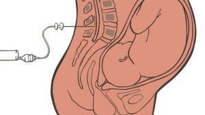 Эпидуральная анестезия при родах: отзывы врачей и недостатки