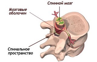 Эпидуральная и спинальная анестезия, отличия, что лучше