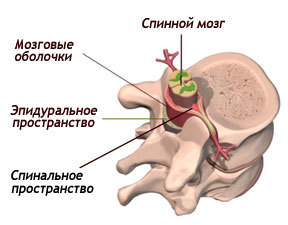 Эпидуральная и спинальная анестезия, отличия, что лучше