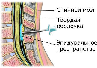 Эпидуральная и спинальная анестезия, отличия, что лучше