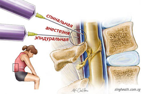 Эпидуральная и спинальная анестезия, отличия, что лучше