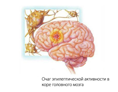 Эпилепсия, лечение у взрослых, можно ли вылечить полностью и навсегда