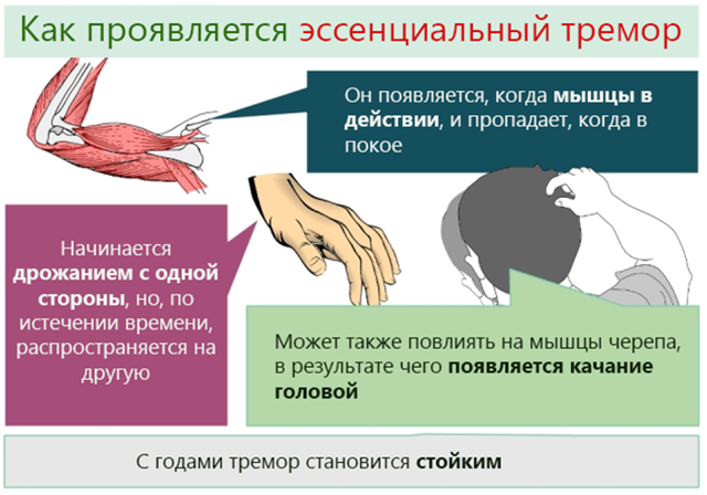 Эссенциальный тремор: причины, симптомы и лечение минора рук, головы