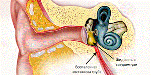 Евстахиит: симптомы и лечение тубоотита, признаки хронического и острого евстахиита, как лечить евстахиит