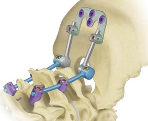 Фиксация позвонков с помощью микрочипа