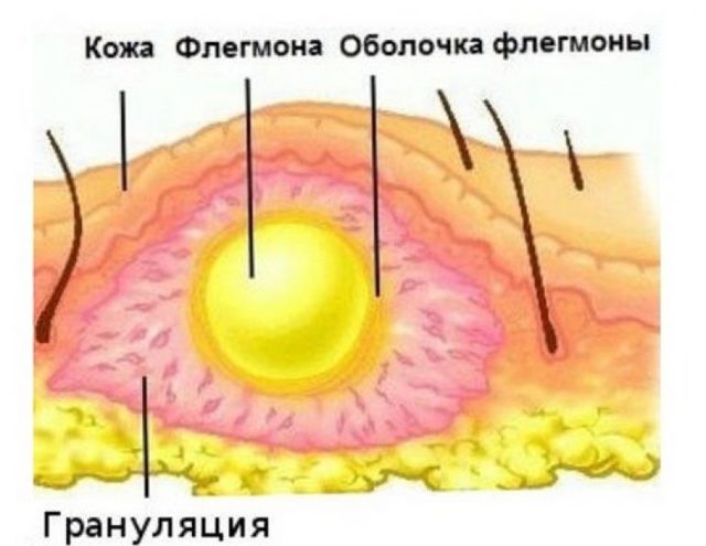 Флегмона глаза — причины, симптомы флегмоны глазницы, века, слезного мешка, диагностика и лечение