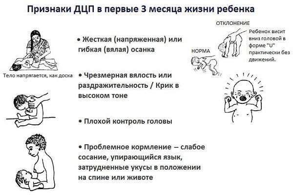 Формы и причины детского церебрального паралича: риски дцп при родах и при беременности