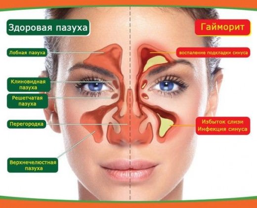 Гайморит и народные средства — как вылечить гайморит в домашних условиях / народная медицина
