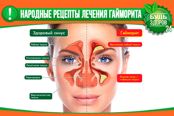 Гайморит и народные средства — как вылечить гайморит в домашних условиях / народная медицина