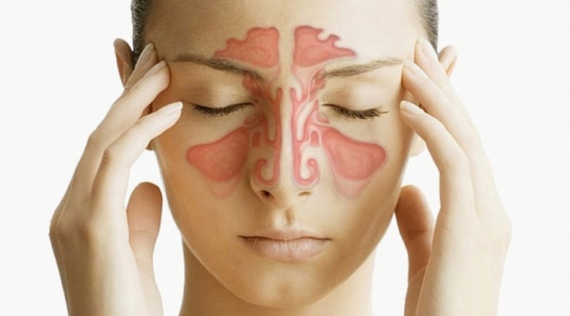 Гайморит и народные средства — как вылечить гайморит в домашних условиях / народная медицина