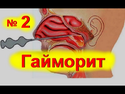 Гайморит и народные средства — как вылечить гайморит в домашних условиях / народная медицина