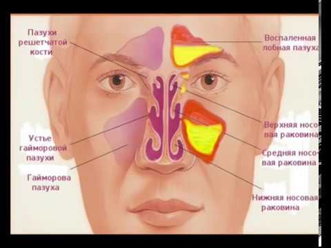 Гайморит, лечение гайморита народными средствами в домашних условиях