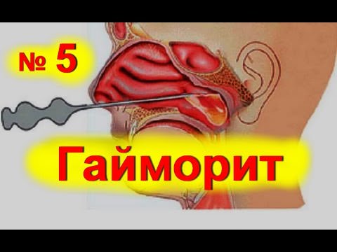 Гайморит, лечение гайморита народными средствами в домашних условиях