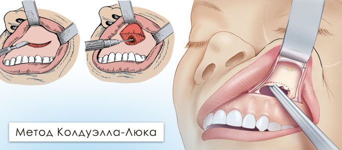 Гайморотомия: операция на гайморовой пазухе. показания