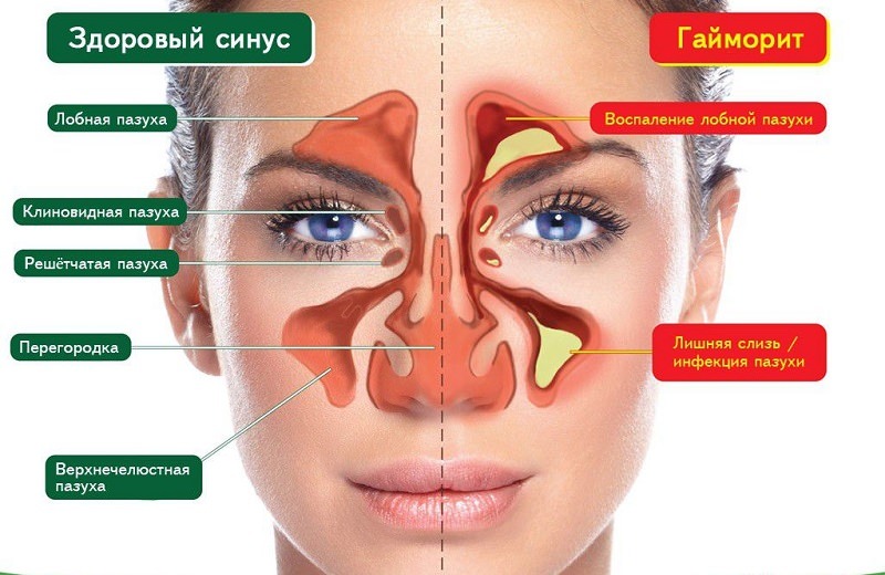 Гайморовы пазухи носа: причины воспаления. лечение