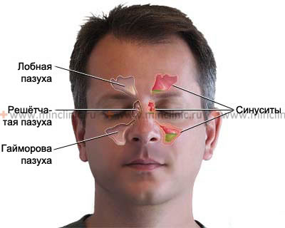 Гайморовы пазухи носа: причины воспаления. лечение